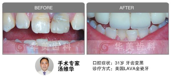 美国LAVA全瓷牙修复牙齿发黑前后效果图对比图片