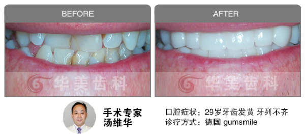 德国GumSmile修复牙齿不齐前后效果图对比图片