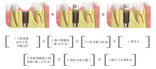 种植牙过程图解