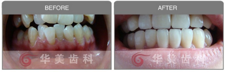 我要矫正多生牙《点击咨询》